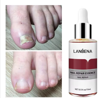 Antihongos para uñas